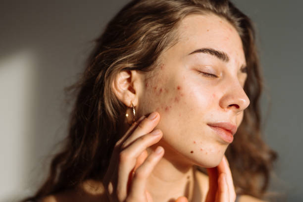 istock Young Woman with a problem skin. 2030426553