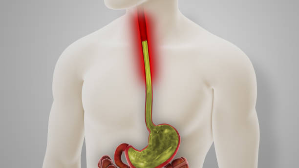 istock Acid Reflux GERD Disease 3D Illustration 2030666339