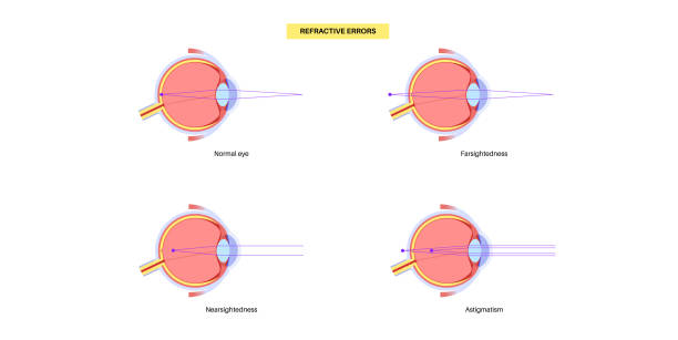 Presbyopia Color 800+ Presbyopia Ilustrasi, Grafik Vektor, & Clip Art Bebas Royalti ...