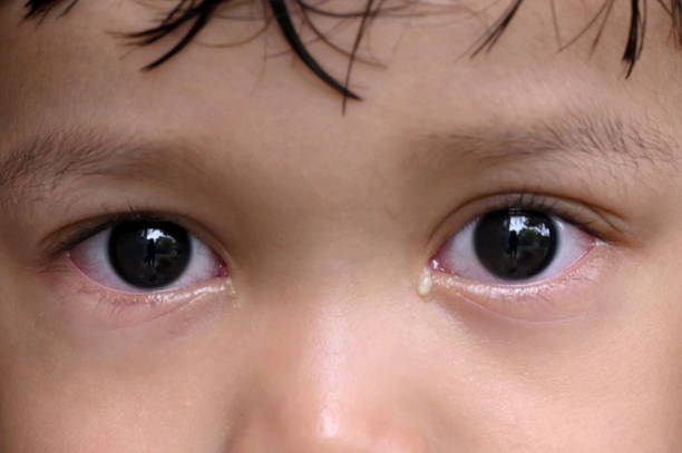 portrait d’un enfant atteint d’une maladie oculaire - conjunctivitis sore eyes child human eye photos et images de collection