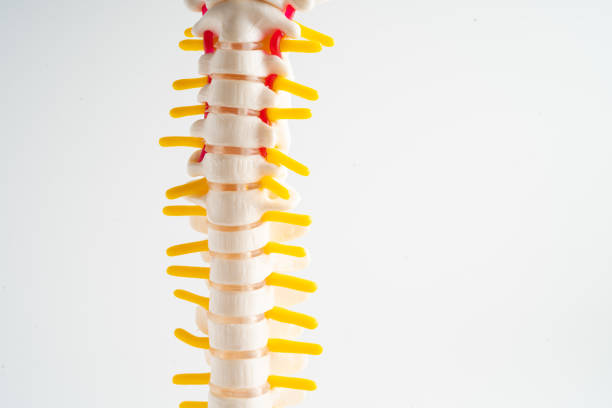 lumbar spine displaced herniated disc fragment, spinal nerve and bone. model for treatment medical in the orthopedic department. - slipped disc fotografías e imágenes de stock