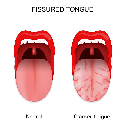 Fissured tongue. Healthy and cracked tongue. Oral cavity anomalies. Vector illustration