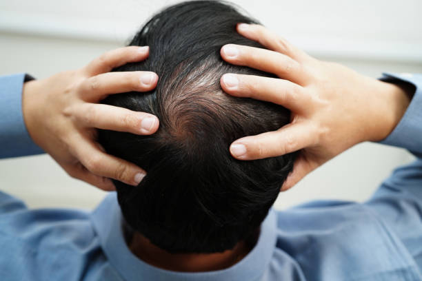 istock Bald head in man, hair loss treatment health problem. 2033844162