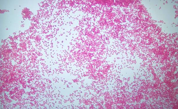Microscopic view of cerebrospinal fluid from a patient with meningococcal meningitis