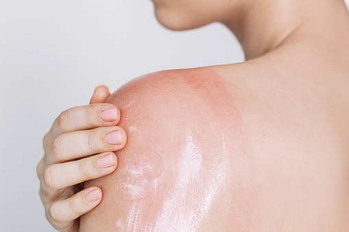 Cropped shot of a young woman applying a soothing anti-burn cream on her shoulder to treat a sunburn, redness of the skin. Traces of top. Tanned skin, contrast of skin colors. Result of tanning