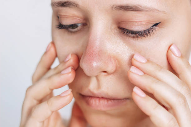 scottature solari, arrossamento del naso. giovane donna preoccupata per la sua pelle rossa del naso. allergie - naso rosso foto e immagini stock