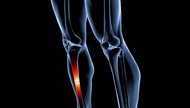 남성 골격에 부러진 경골의 의학적 그림 - orthopedic equipment osteoporosis x ray human spine 뉴스 사진 이미지