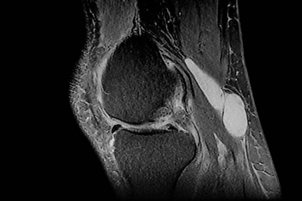 magnetyczny rezonans jądrowy prawego kolana z zaznaczoną torbielą bakera, złamaniem łąkotki zewnętrznej i chorobą zwyrodnieniową stawów. - cysta zdjęcia i obrazy z banku zdjęć