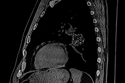 Lateral view of chest CAT- SCAN that shows popcorn calcification a hamartoma tumor on the left lung. Medical themes