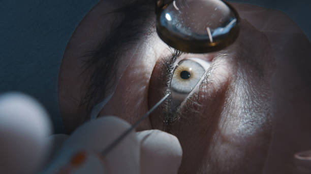 istock Close-up. Patient and surgeon in operating room during ophthalmic surgery or diagnosis. Open eye. Patient under sterile cover. 2037762933