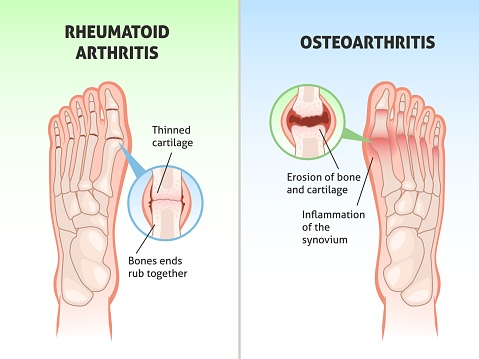Foot Dysfunction Foot Disease Poster Medical Orthopedic Scheme Foot Bones Defects Joint ...