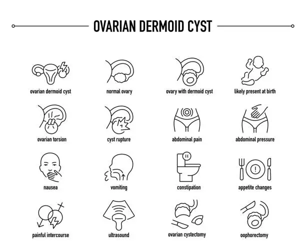 Vector illustration of Ovarian Dermoid Cyst symptoms, diagnostic and treatment vector icons. Line editable medical icons.