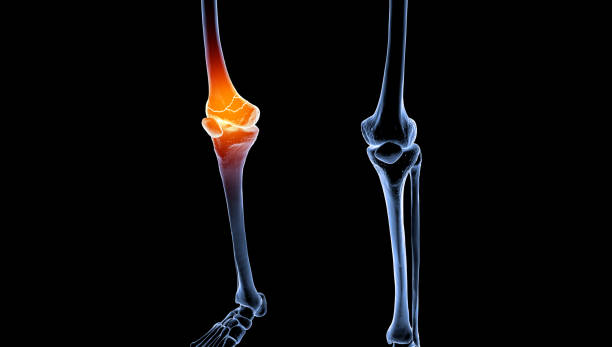 medical illustration of lower broken femur on male athletic body - orthopedic equipment osteoporosis x ray human spine 뉴스 사진 이미지