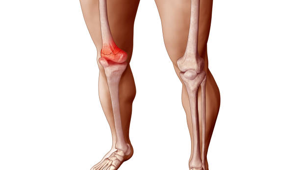 남성 운동 신체에 하부 부러진 대퇴골의 의학적 삽화 - orthopedic equipment osteoporosis x ray human spine 뉴스 사진 이미지