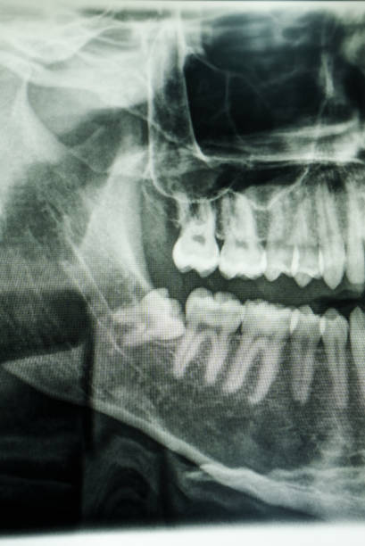 Panoramic radiography (orthopantomography) by means of X-rays showing the dental structure