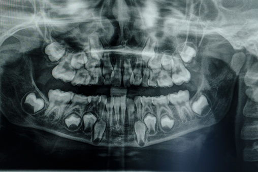 Panoramic radiography (orthopantomography) by means of X-rays showing the dental structure