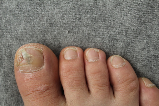 Damaged toenail plate close-up. Nail and skin diseases fungus.