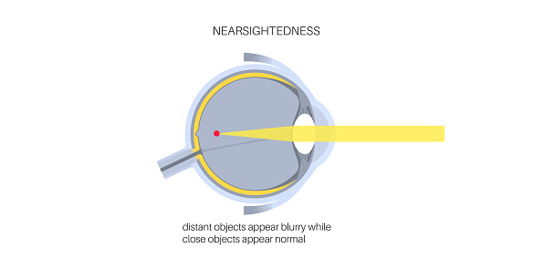 Nearsightedness eye disease poster. Myopia or short sightedness refractive error concept, problem of blurred vision. Anatomy of human eye infographic, lens and retina medical flat vector illustration