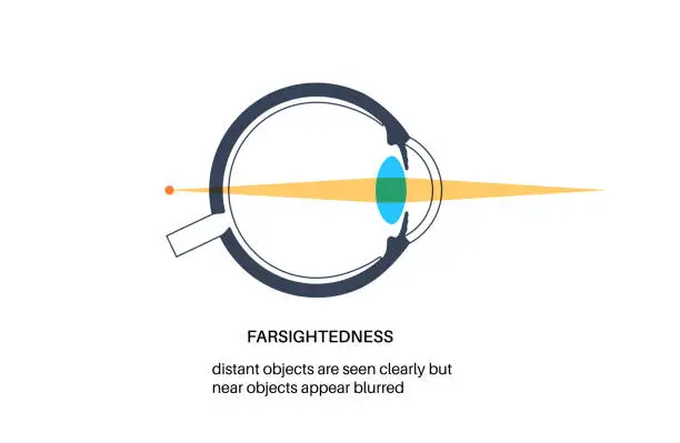 Vector illustration of Farsightedness eye disease