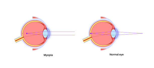 Normal eye and nearsightedness Nearsightedness eye disease poster. Myopia or short sightedness refractive error concept, problem of blurred vision. Anatomy of human eye infographic, lens and retina medical flat vector illustration myopic stock illustrations