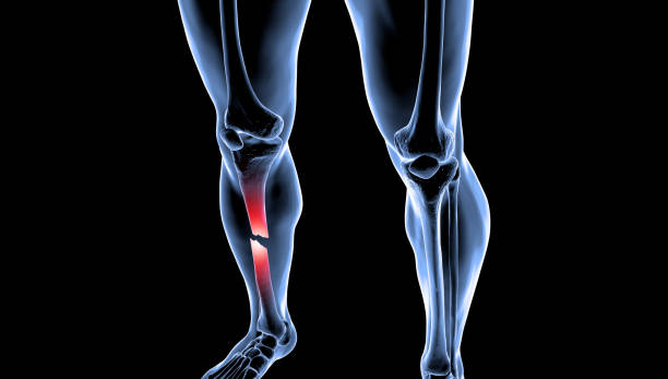 medical illustration of the human male legs with broken lower bones tibia and fibula - orthopedic equipment osteoporosis x ray human spine 뉴스 사진 이미지