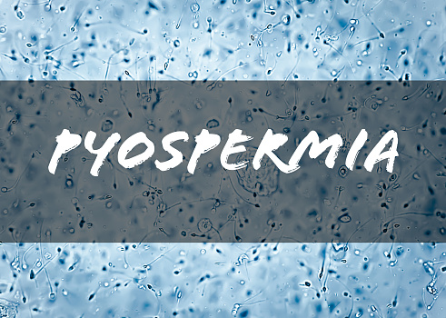 Pyospermia medical term, a high number of white blood cells or puus cell in semen. It can weaken sperm and affect fertility