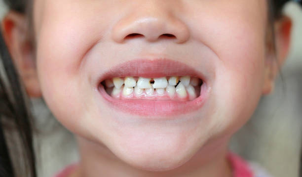 istock Close-up little girl with a teeth broken and rotten. 2040438276