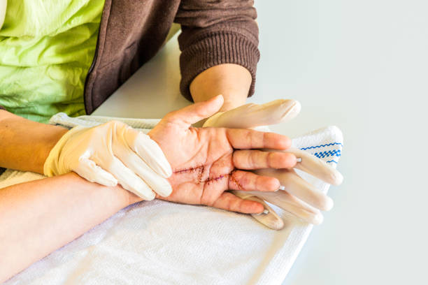 Hand dermatitis. Hand eczema closed on white background. Dermatitis is an inflammation of the skin