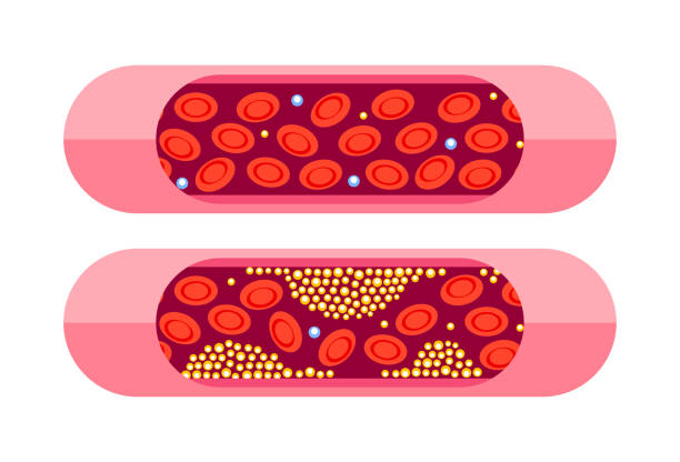 Types of cholesterol. HDL and LDL cholesterol types. Labeled educational normal and narrowed artery. Vector illustration Types of cholesterol. HDL and LDL cholesterol types. Labeled educational normal and narrowed artery. Vector illustration. triglyceride stock illustrations