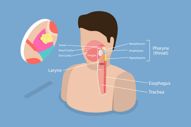 비인두 암종 종양의 3d 등각 평면 벡터 개념 그림 - laryngoscopy stock illustrations