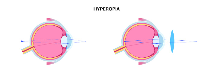 Farsightedness eye disease poster. Hyperopia or long sightedness refractive error concept, problem of blurred vision. Anatomy of human eye, lens and retina, hypermetropia medical vector illustration
