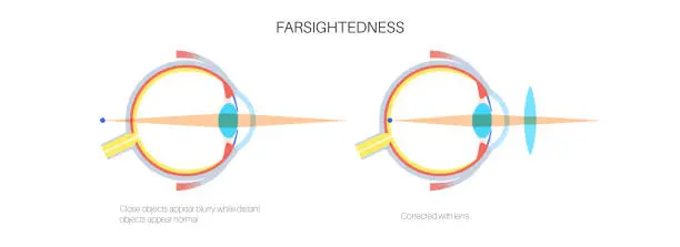 Vector illustration of Normal eye and farsightedness