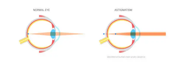 Vector illustration of Astigmatism eye disease