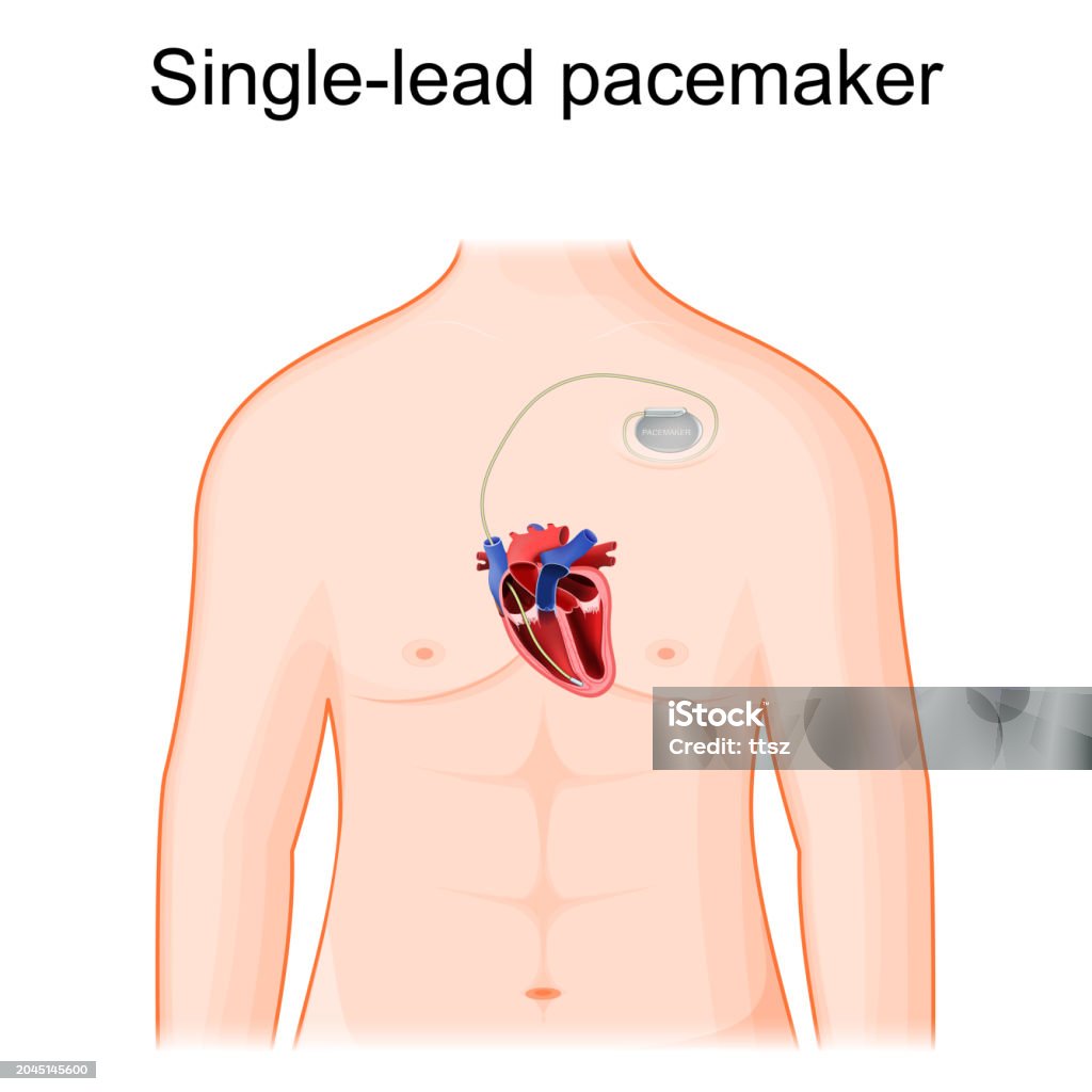 Spacemaker Lead Single Lead Pacemaker Placement Cross Section Of Heart And Artificial ...
