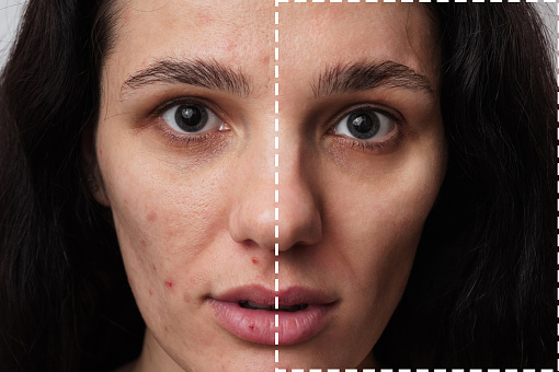 A close-up shot of the face of a young woman with skin problems - pimples, acne, enlarged pores. with and without filter.
