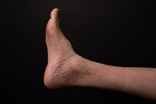 Disabled  legs/feet with high instep and varicose veins
