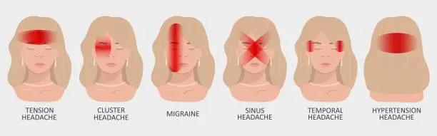 Vector illustration of Vector illustration of a girl having a headache. Localization and types of headaches. Neurology and medicine.