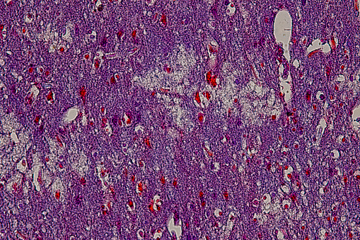 Lymphocytic myocarditis. Myocarditis is an inflammation of the heart muscle. Lymphocytic refers to the type of cell seen in the affected tissue. A lymphocyte is a type of immune function cell.