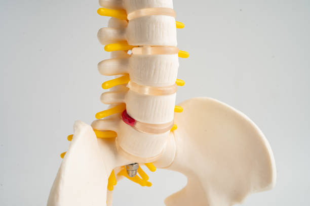 lumbar spine displaced herniated disc fragment, spinal nerve and bone. model for treatment medical in the orthopedic department. - slipped disc fotografías e imágenes de stock