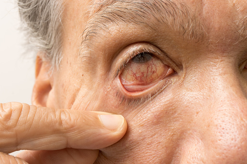 Man suffering from a with a Pink Eye infection in his eyes