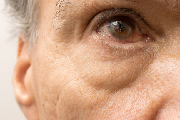 istock Man suffering from Pink Eye 2048610224
