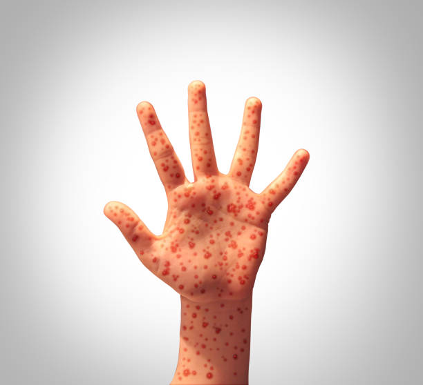 Measles Disease Outbreak Measles Disease Concept as a Hand with a viral illness infection spread as Koplik spots on the skin and the dangers of spreading the contagious virus in public as a health care risk concept. measles stock pictures, royalty-free photos & images