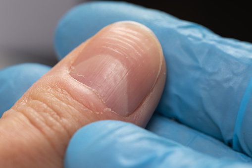 Doctor in gloves examining a ridged fingernails with vertical and horizontal ridges. Nails problems photo