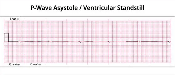 Vector illustration of ECG P wave Asystole - Ventricular Standstill - 8 Second ECG Paper