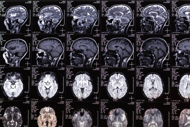 mrt-, mrt-, ct-scan-bild des menschlichen gehirns. medizinisches behandlungskonzept. diagnose der krankheit des menschlichen kopfes. - computertomograph stock-fotos und bilder