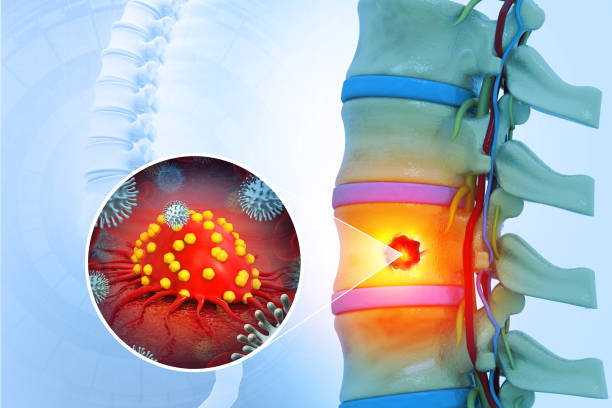 spine cancer or spinal tumor disease. 3d illustration - slipped disk stock-fotos und bilder