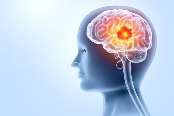 istock Brain tumor or barin cancer. 3d illustration 2053068054