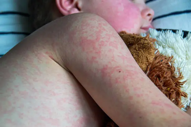 Viral disease. Measles rash on the body of the child. Allergy.