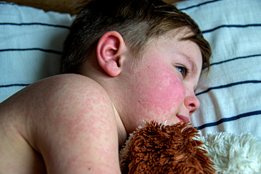 Viral disease. Measles rash on the body of the child. Allergy.