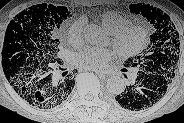 tac- gammagrafía de la enfermedad pulmonar intersticial secundaria a esclerodermia. - interstitial fotografías e imágenes de stock